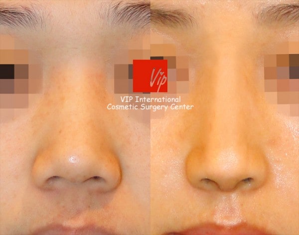 	Harmony-Rhinoplasty, Protruded Mouth Correction Rhinoplasty, Rib cartilage Rhinoplasty	 - Harmony rhinoplasty