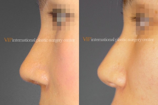 	Nose Surgery	 - Bulbous and deviated nose