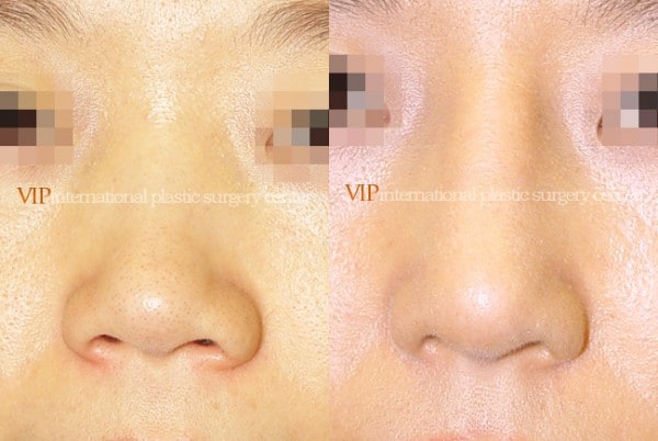 Nose Surgery - Alar base reduction