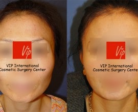 Temple & cheek Fat graft