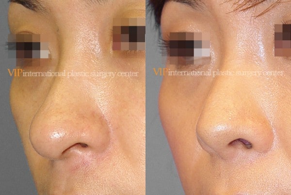 	Nose Surgery	 - Long nose correction