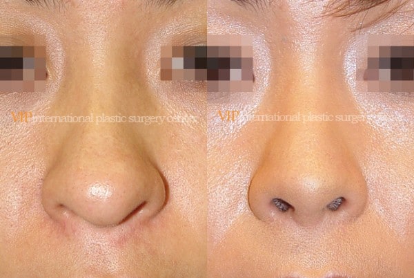 	Nose Surgery	 - Long nose correction