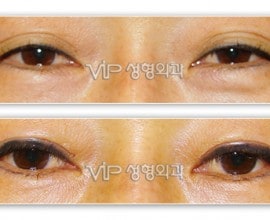 Upper & Lower blepharoplasty