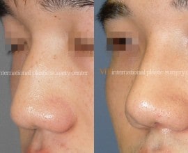 Wide nasal bone reduction rhinoplasty