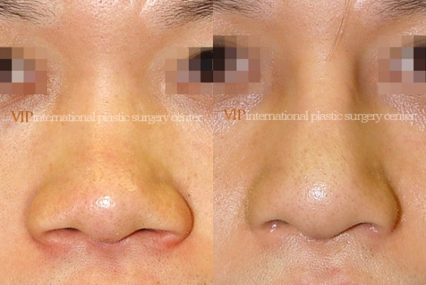 Nose Surgery - Alar base reduction