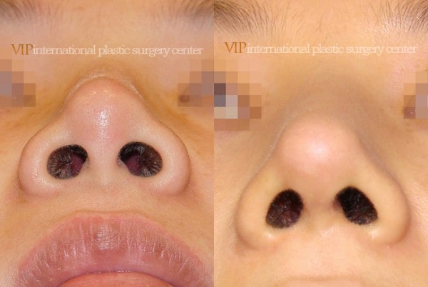 Nose Surgery - Septal cartilage rhinoplasty