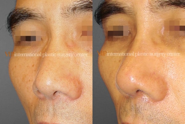 Nose Surgery - Nostril correction