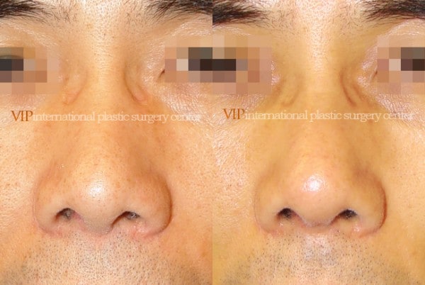 Nose Surgery - Nostril correction