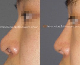 Nostril correction