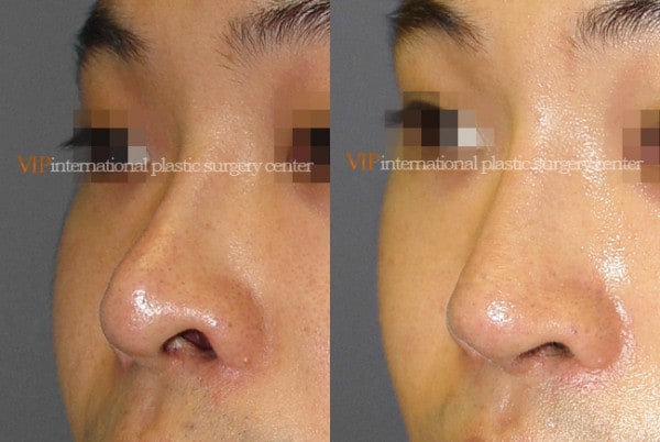 	Nose Surgery	 - Nostril correction