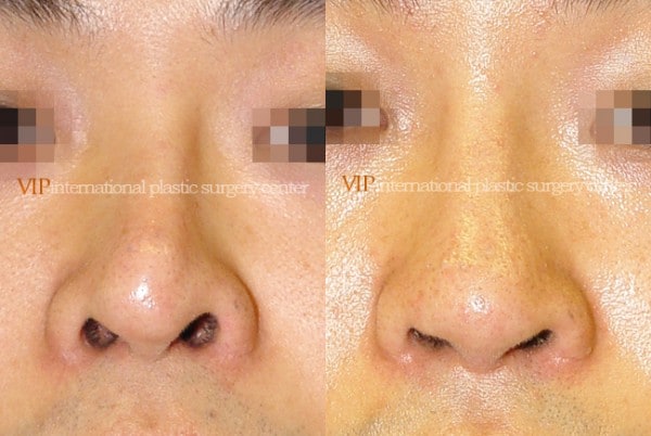 	Nose Surgery	 - Nostril correction