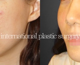 Cheek bone augmentation