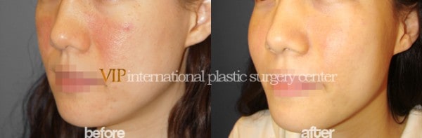 Facial Bone Surgery - Cheek bone augmentation