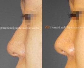 Rhinoplasty