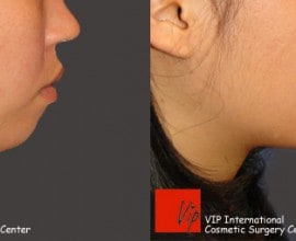 Genioplasty - bringing chin bone forward