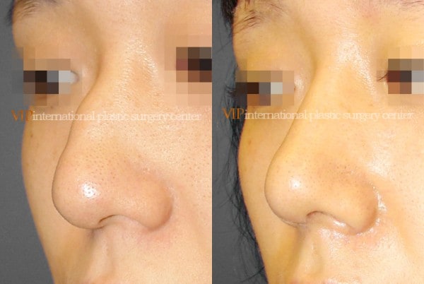 Nose Surgery - Rhinoplasty