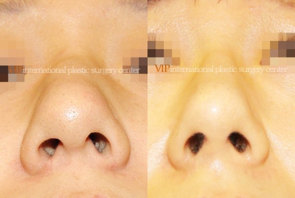 Nose Surgery - Rhinoplasty