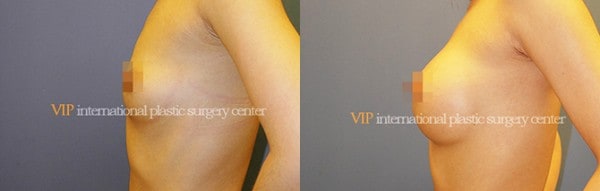 Breast Surgery - Breast surgery