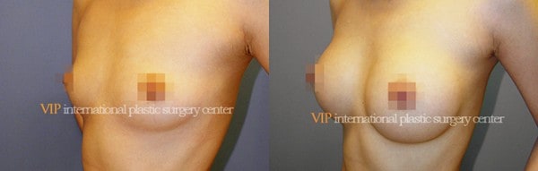 Breast Surgery - Breast surgery