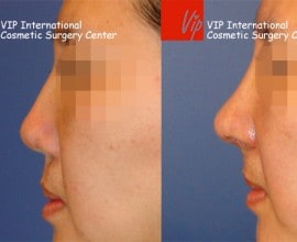 Cleft lip correction - Rib cartilage rhinoplasty