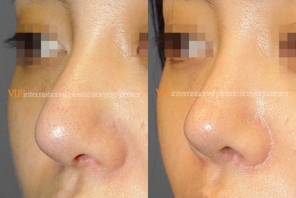 	Nose Surgery	 - Long and Bulbous nose correction