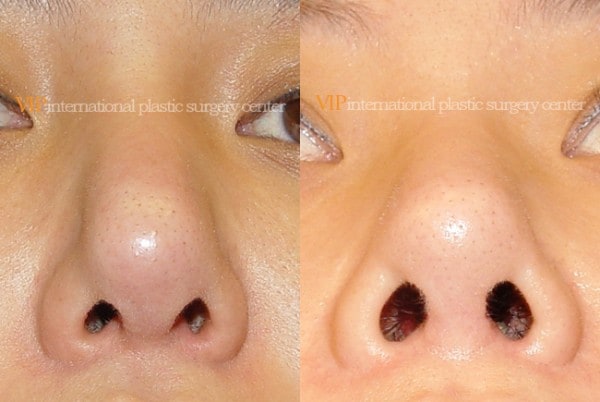 	Nose Surgery	 - Long and Bulbous nose correction