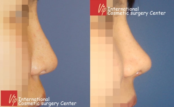 	Nose Surgery, Rib cartilage Rhinoplasty, Revision Rhinoplasty	 - Deviated nose correction