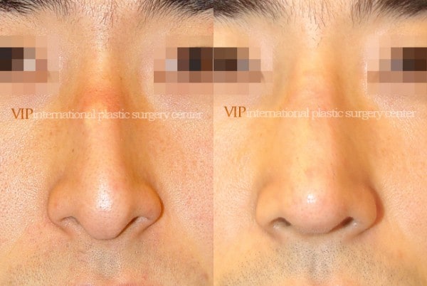 Nose Surgery - Nose bridge correction