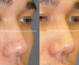 Wide nasal bone reduction rhinoplasty