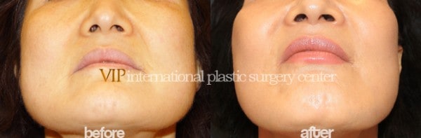 Face Lift - Wrinkle surgery