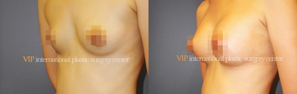 Breast Surgery - Breast surgery