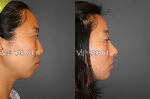 	Harmony-Rhinoplasty, Protruded Mouth Correction Rhinoplasty, Rib cartilage Rhinoplasty	 - VIP Harmony rhinoplasty