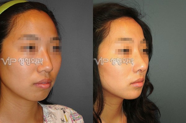 	Harmony-Rhinoplasty, Protruded Mouth Correction Rhinoplasty, Rib cartilage Rhinoplasty	 - VIP Harmony rhinoplasty