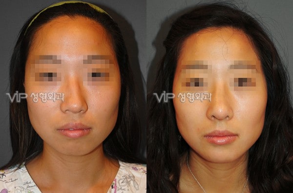 	Harmony-Rhinoplasty, Protruded Mouth Correction Rhinoplasty, Rib cartilage Rhinoplasty	 - VIP Harmony rhinoplasty