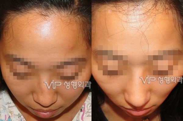 	Harmony-Rhinoplasty, Protruded Mouth Correction Rhinoplasty, Rib cartilage Rhinoplasty	 - VIP Harmony rhinoplasty