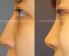 Nose bridge correction