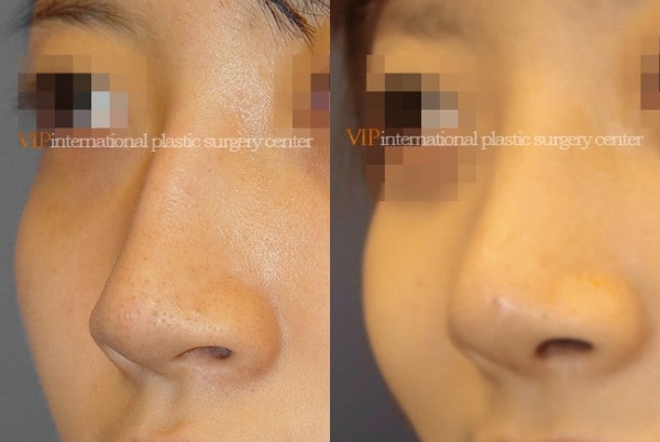 Nose Surgery - Nose bridge correction