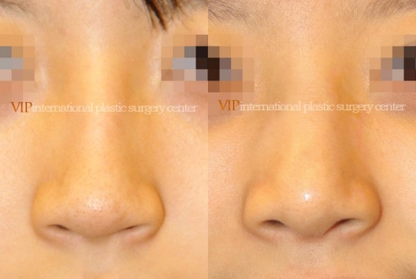 Nose Surgery - Nose bridge correction