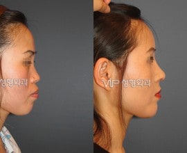 VIP Harmony rhinoplasty