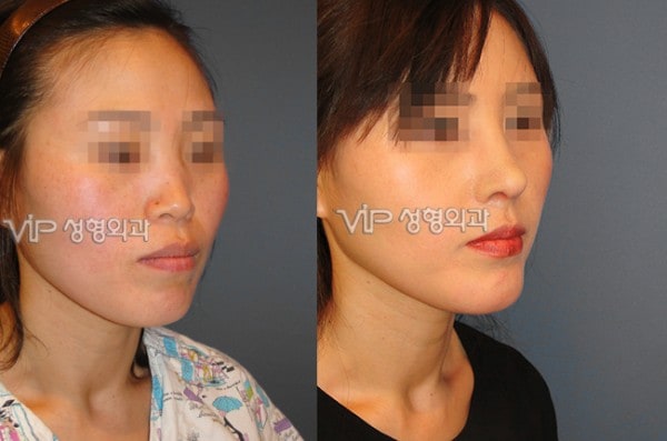 Nose Surgery - VIP Harmony rhinoplasty