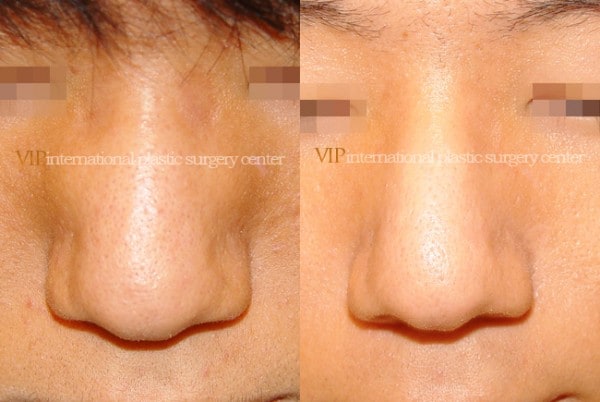 	Nose Surgery	 - Wide nasal bone reduction rhinoplasty