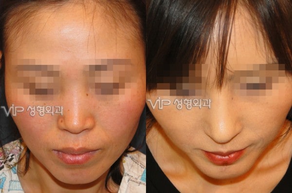 Nose Surgery - VIP Harmony rhinoplasty
