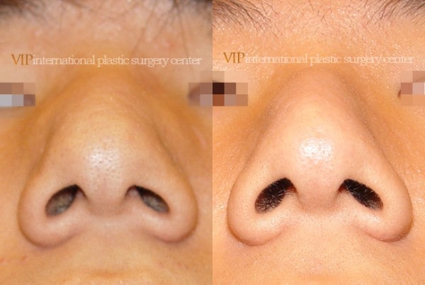 	Nose Surgery	 - Wide nasal bone reduction rhinoplasty