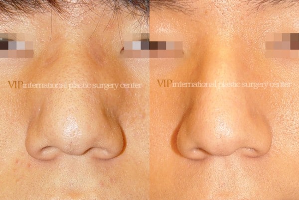 	Nose Surgery	 - Wide nasal bone reduction rhinoplasty