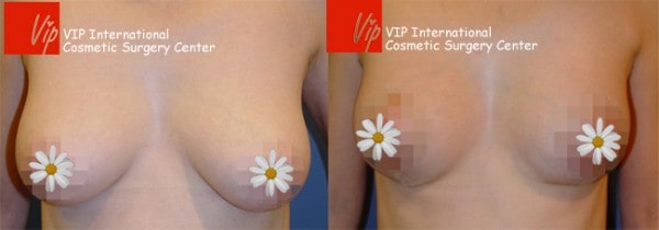 Breast Surgery - Breast reduction
