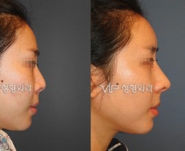 Rib cartilage rhinoplasty