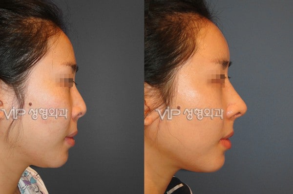 	Rib cartilage Rhinoplasty, Contracted Nose, Revision Rhinoplasty	 - Rib cartilage rhinoplasty