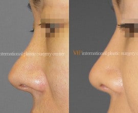 Silicone showing nose correction