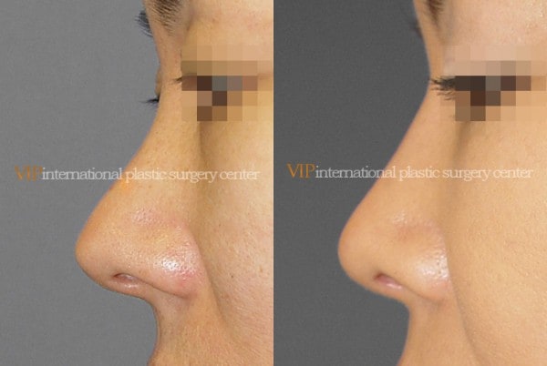 	Nose Surgery, Revision Rhinoplasty	 - Silicone showing nose correction