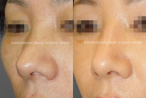 	Nose Surgery, Revision Rhinoplasty	 - Silicone showing nose correction